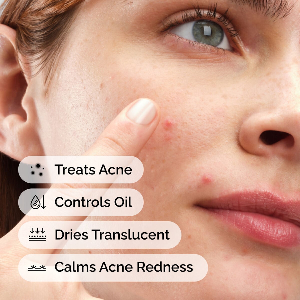 sulfur-10-powder-to-cream-concentrate-h7 ord-sulfur-10pct-powder-to-cream-concentrate-model-application-with-benefits-acne.jpg